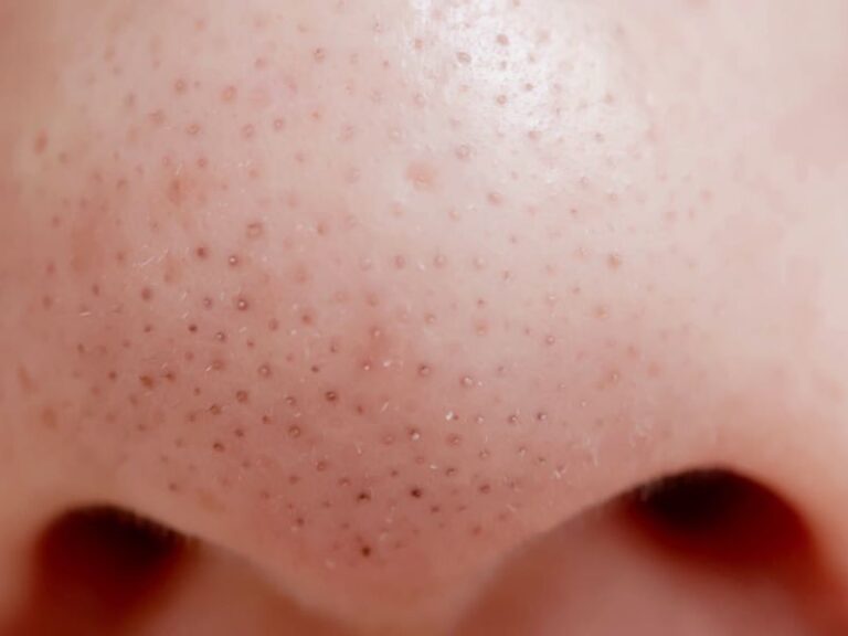 Mitiseri su oksidovani čepovi sebuma u porama, često izazvani hormonima i poremećenom keratinizacijom.